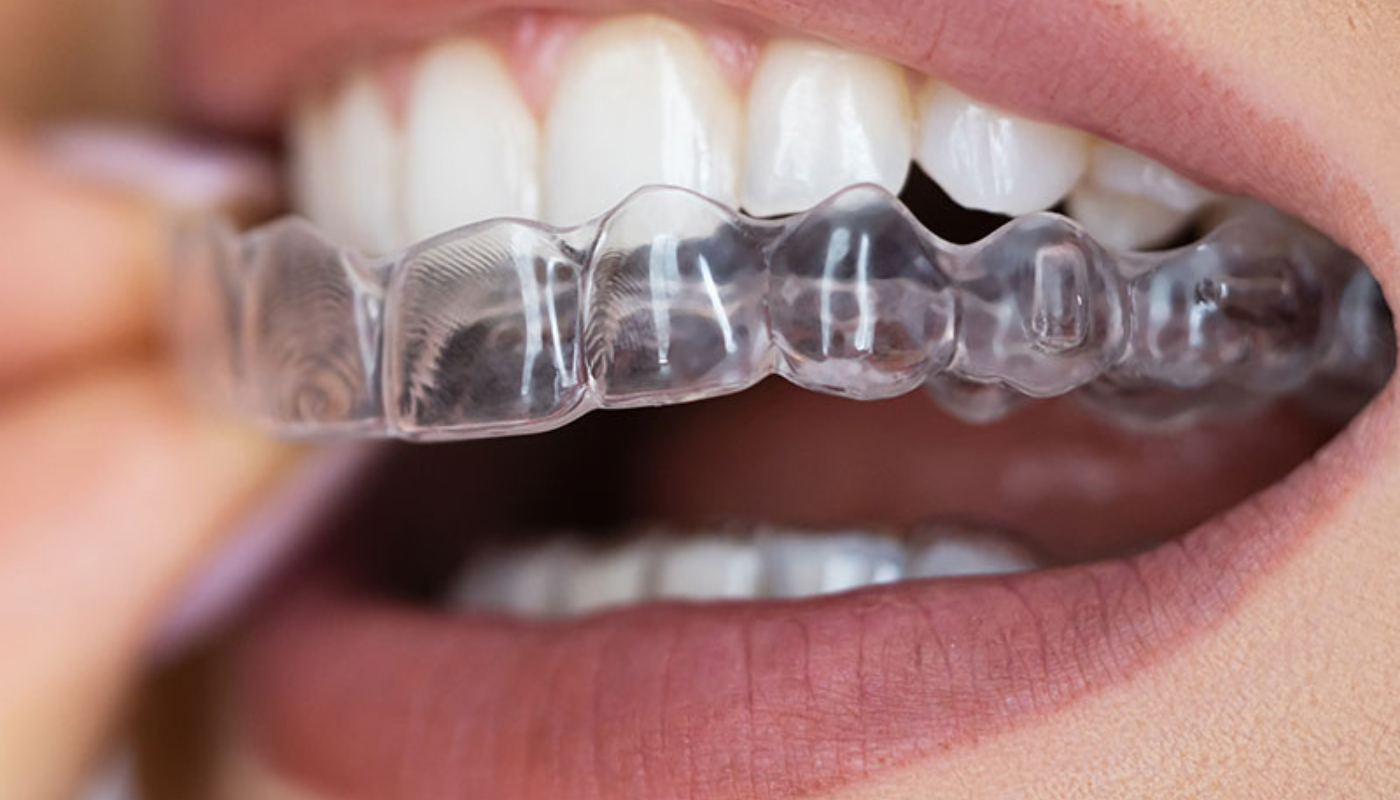 Orthodontie invisible